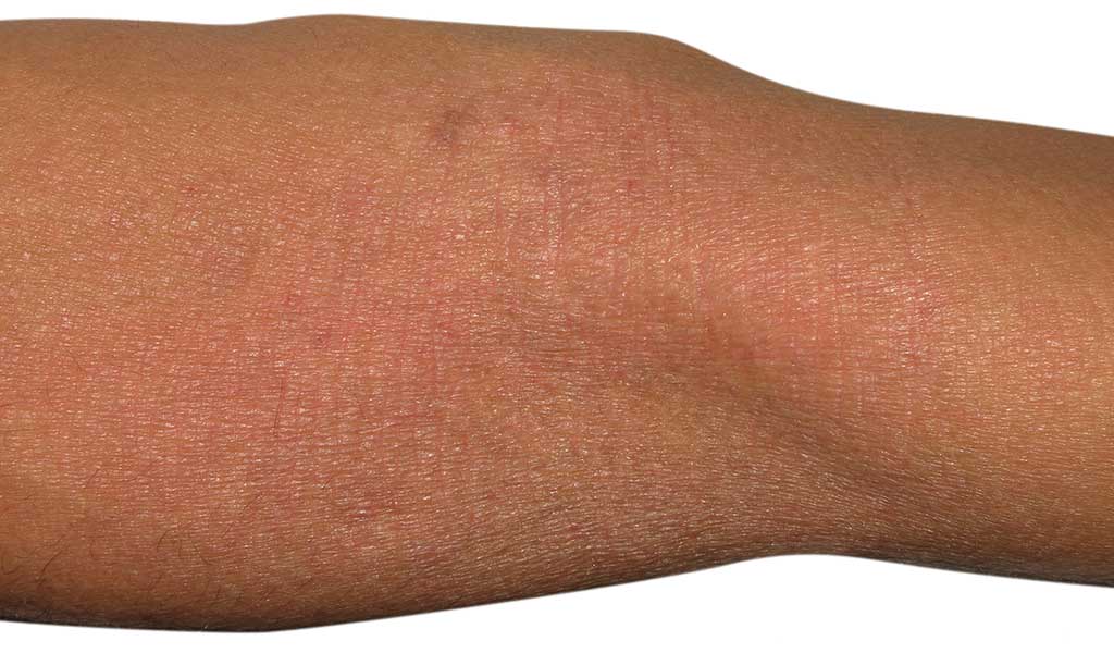 Neurodermitis - verletzte Haut