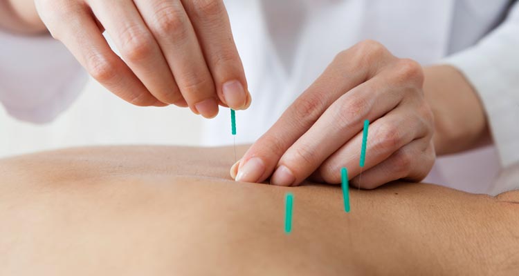 Akupunktur bei Neurodermitis