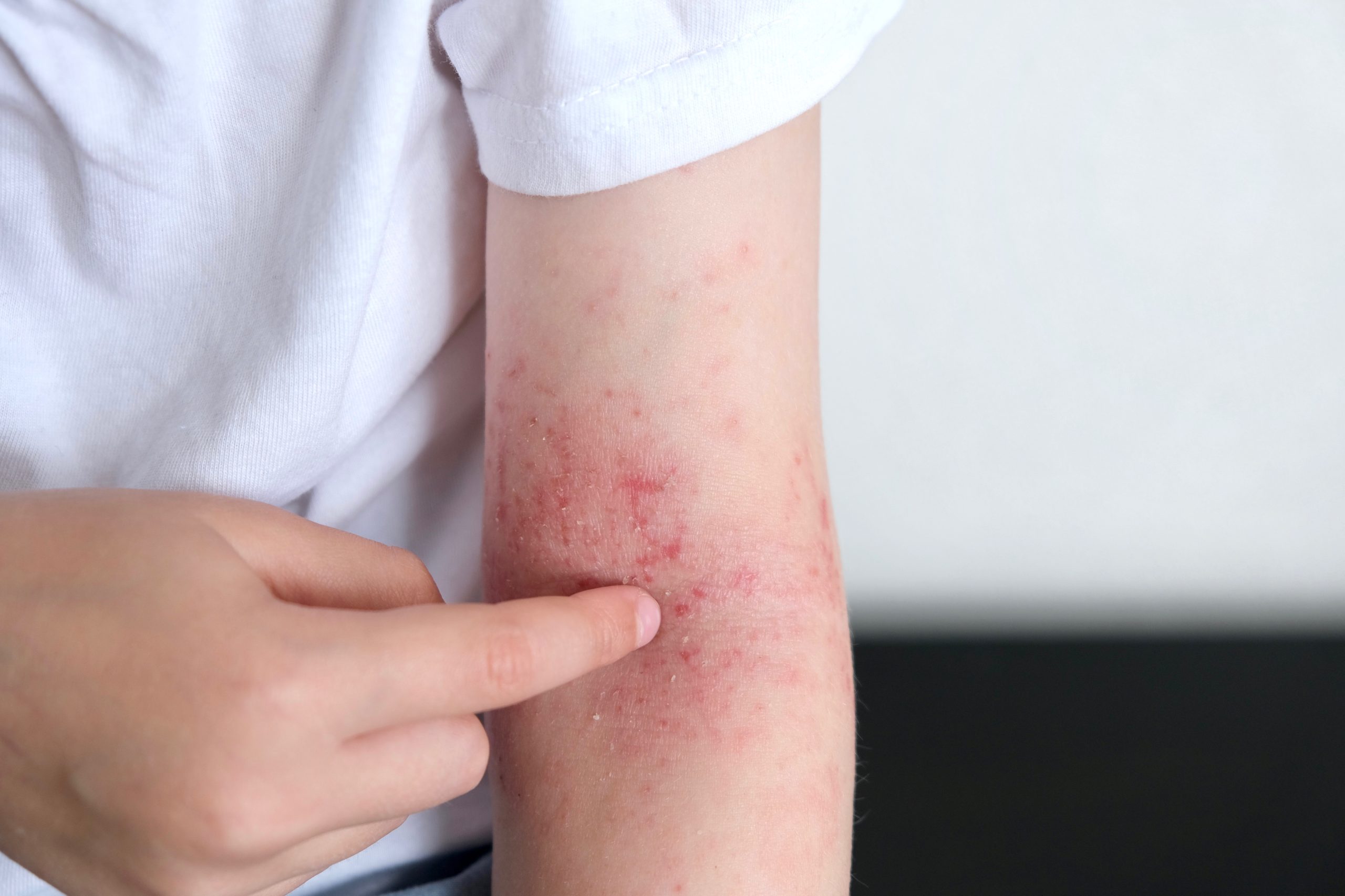 Arm, auf dem typische Symptome von Neurodermitis zu erkennen sind.